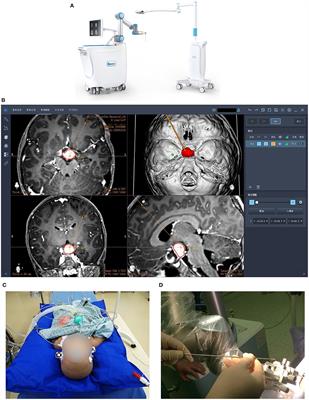 A Bulk Retrospective Study of Robot-Assisted Stereotactic Biopsies of Intracranial Lesions Guided by Videometric Tracker